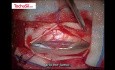 Application de la Matrice de Scellement TachoSil dans la Réparation de la Durotomie Rachidienne