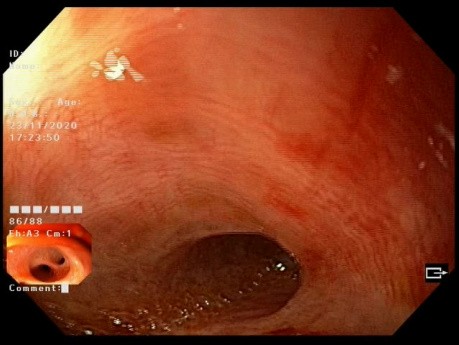 Endoscopie digestive haute après CPRE