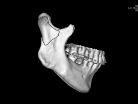 Et si l'on Prévoyait plus d'Espace pour la Plaque lors de l'Ostéosynthèse du Condyle Mandibulaire ? – Podcast