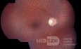 Fundus albipunctatus