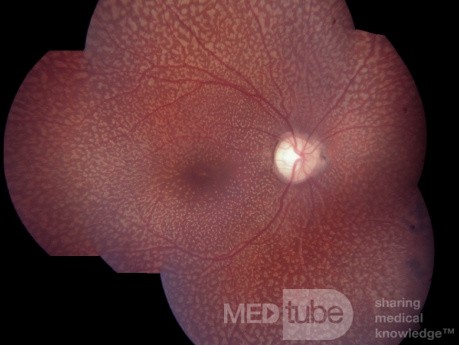 Fundus albipunctatus