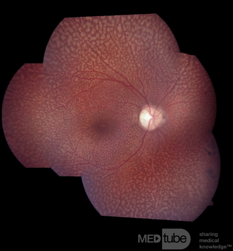 Fundus albipunctatus