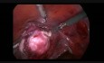 Myomectomie laparoscopique avec une ligature des artères utérines