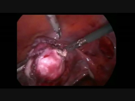 Myomectomie laparoscopique avec une ligature des artères utérines