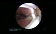 Résection hystéroscopique sur septum intra-utérin complet jusqu'à l'OS interne