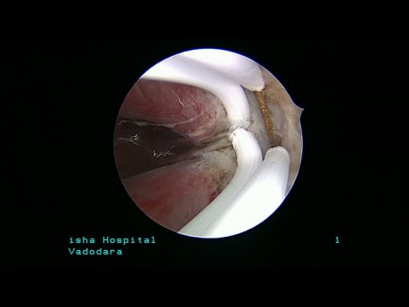 Résection hystéroscopique sur septum intra-utérin complet jusqu'à l'OS interne