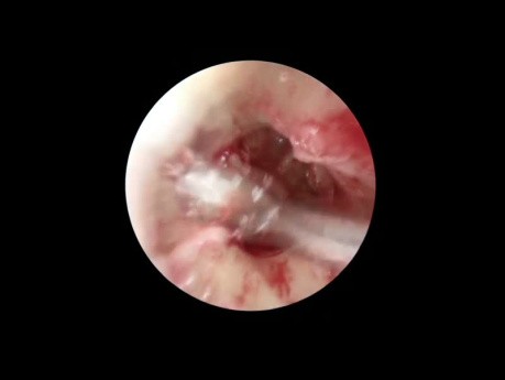 Tympanoplastie Endoscopique pour la Tympanosclérose