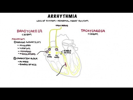 Arythmies - Mécanisme de la bradyarythmie et de la tachyarythmie