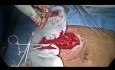 Inversion laparoscopique de la procédure de Hartmann
