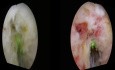 Rétrécissement de l'Urètre. Urétrotomie au Laser Holmium - Sténose de l'Urètre.