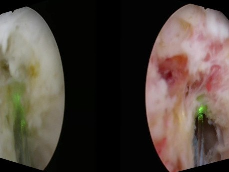 Rétrécissement de l'Urètre. Urétrotomie au Laser Holmium - Sténose de l'Urètre.