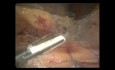 Résection antérieure basse du rectum par voie cœlioscopique en raison du cancer du rectum