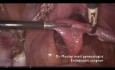 Sacrocolpopexie pour le prolapsus génito-urinaire - Trucs et astuces