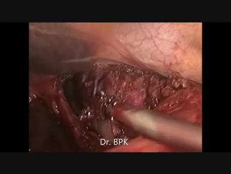 Oesophagectomie thoraco-laparoscopique
