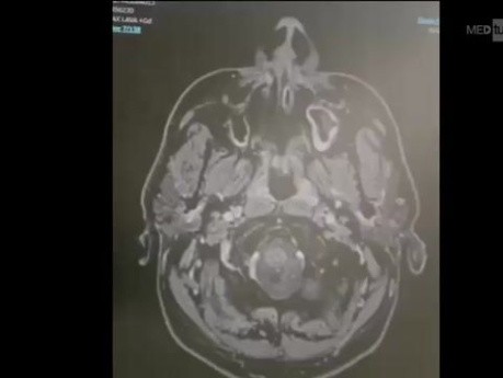 Résection de Shwannome Vestibulaire Gauche par Craniotomie Rétrosigmoïdienne Gauche