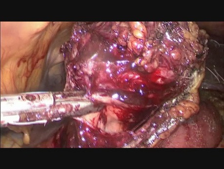 Résection laparoscopique d'un grand GIST gastrique