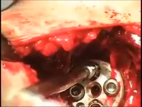 Arthroplastie de l'Epaule - Prothèse Totale d'Epaule Inversée (PTEI)