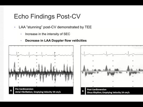 Utilisation de l'Echographie dans l'Evaluation des causes Cardiaques des Embolies