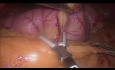 Gastrectomie Sleeve Coelioscopique
