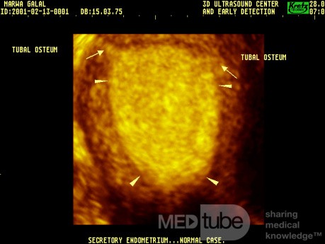 Endomètre de la phase sécrétoire du cycle menstruel - Echographie tridimensionnelle