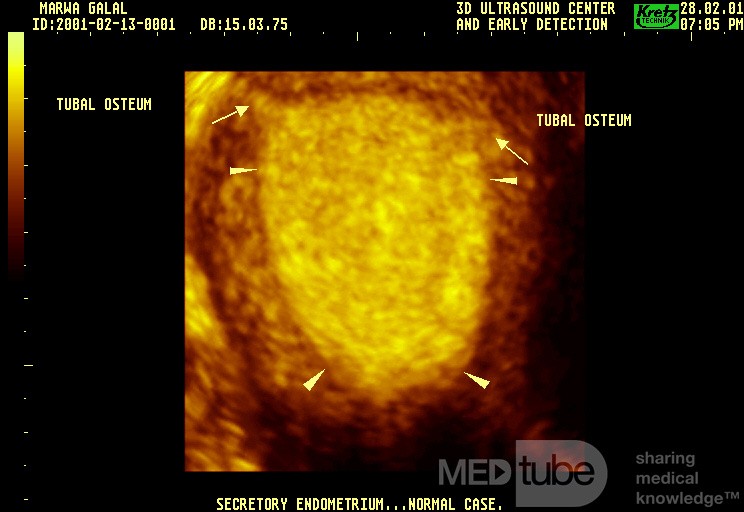 Endomètre de la phase sécrétoire du cycle menstruel - Echographie tridimensionnelle