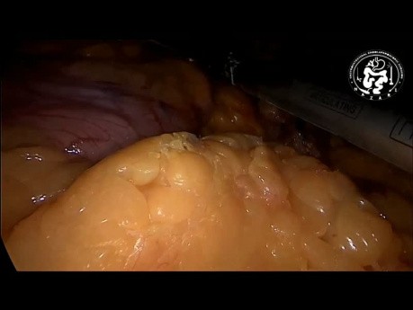 Gastrectomie en manchon laparoscopique