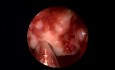 Résection d'une Tumeur Nasale de Type Tératome – Chirurgie des Sinus