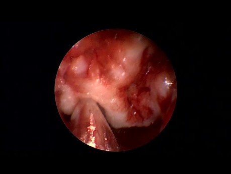 Résection d'une Tumeur Nasale de Type Tératome – Chirurgie des Sinus