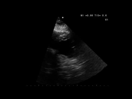 Quiz d'échocardiographie. Toute anomalie de fonction systolique du ventricule gauche