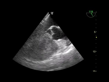 Quiz d'échocardiographie transœsophagienne - cas rare et la révision de certaines vues de base