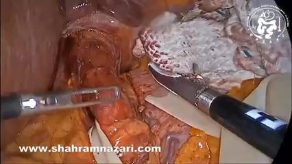 Achalasie et Perforation Muqueuse : Réparation d'une Perforation Détectée en Peropératoire 