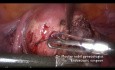 Myomectomie ambulatoire sans effusion de sang