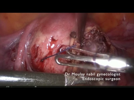 Myomectomie ambulatoire sans effusion de sang