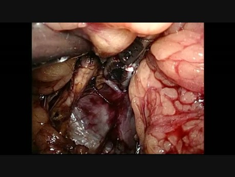 Surrénalectomie droite par laparoscopie rétropéritonéale