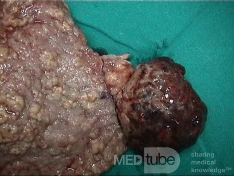 Le tumeur mixte mésodermique maligne. L' utérus.    2