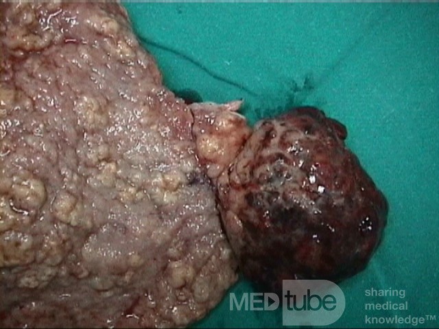 Le tumeur mixte mésodermique maligne. L' utérus.    2