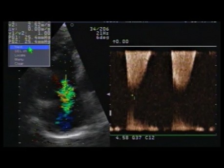 Cardiomyopathie ventriculaire droite arythmogène (CVDA ou DVDA). Cas clinique avec ECG et échocardiographie