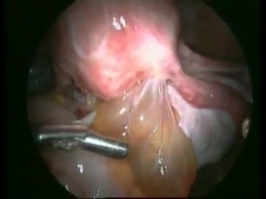Prise en charge laparoscopique d'un nodule d'endométriose de la cloison recto-vaginale