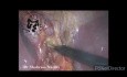 Cholécystectomie laparoscopique après microperforation ERCP / remplacement de l'artère hépatique droite