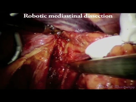 Œsophagectomie Trans-Hiatale Laparoscopique Robotisée