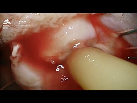 Endocardite sur Valve Mitrale - Patil Aarti