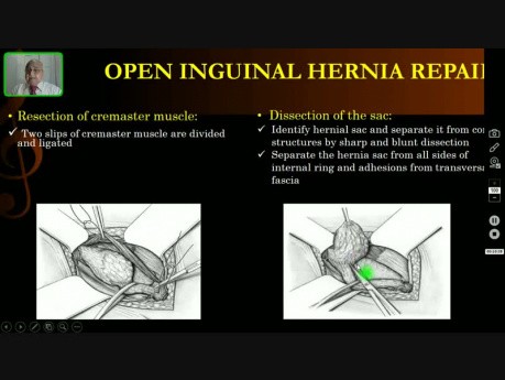 Réparation d'une Hernie Inguinale Ouverte 