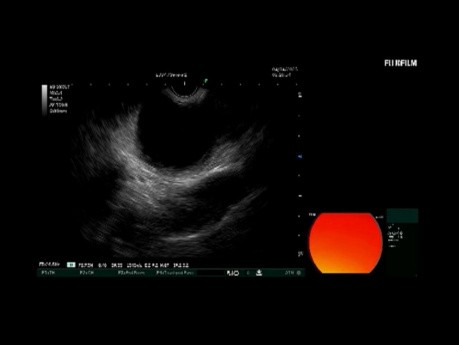 Kysto-gastrostomie écho-endoscopique