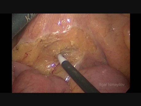 Hémicolectomie gauche par voie laparoscopique. L'exérèse complète du mésocolon par voie laparoscopique pour cancer du côlon sigmoïde