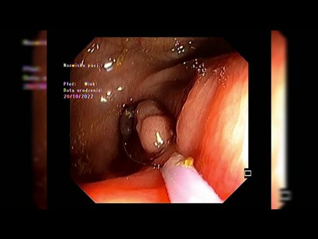 Mucosectomie de Lésion Péri-Appendiculaire après Incision Muqueuse Circonférentielle Partielle