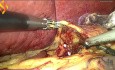 Gastrectomie partielle en raison de la tumeur stromale digestive (GIST) de petite courbure