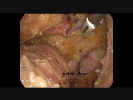 Résection antérieure basse par voie laparoscopique en raison de cancer du rectum
