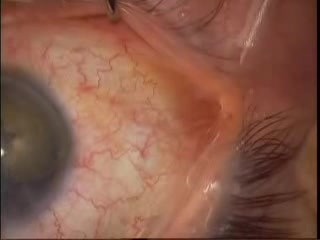 Phacoémulsification - cataracte blanche