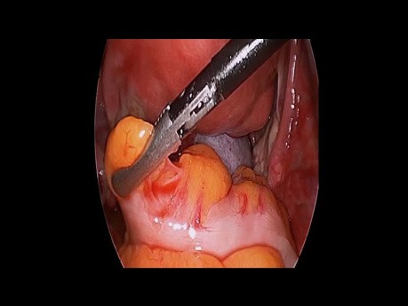 Torsion Ovarienne Aigue sur Tératome