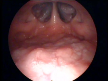 Technique de Naso-pharyngoscopie Tans-orale - Vue du Nasopharynx